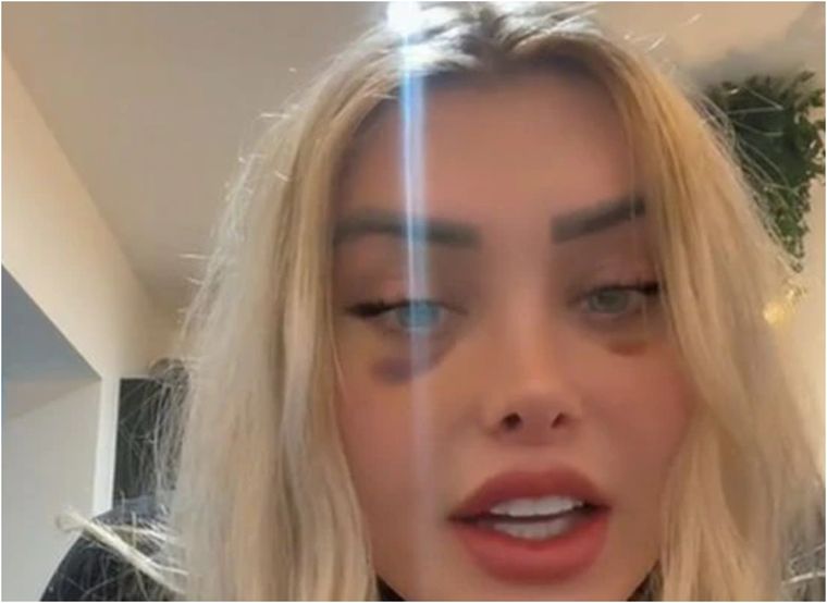 Subir a un avión después de operarse fue una mala idea para esta estrella de las redes sociales para adultos