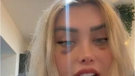 Subir a un avión después de operarse fue una mala idea para esta estrella de las redes sociales para adultos